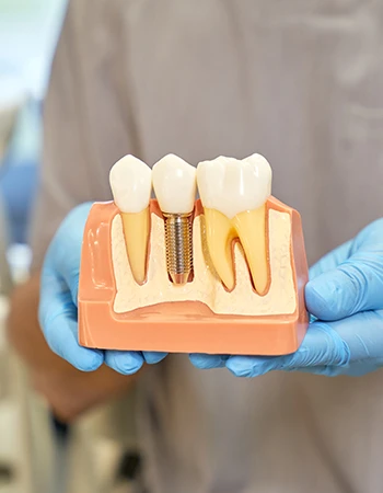 implantes dentales en Arganda del Rey