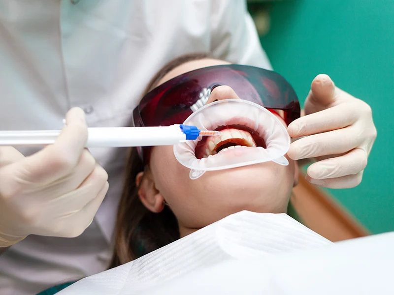blanqueamiento dental trat3