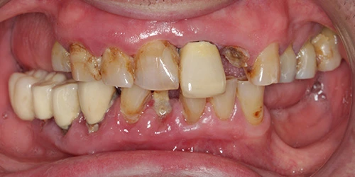 Casos Dentales en Arganda del Rey